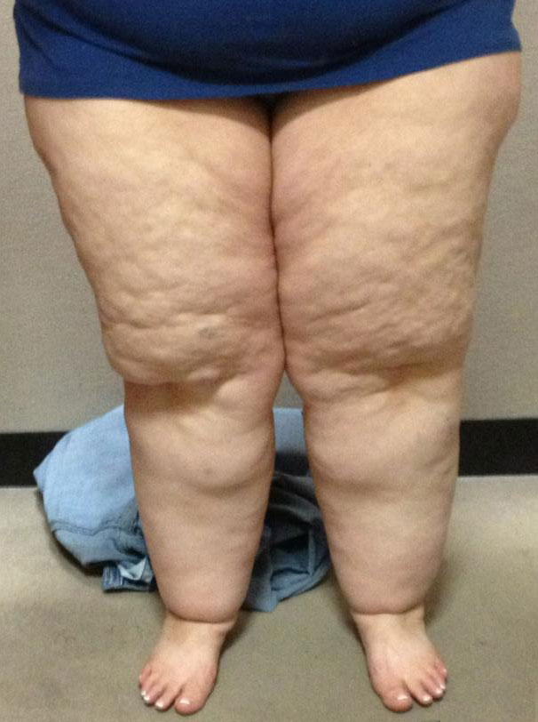 lipedema painful fat